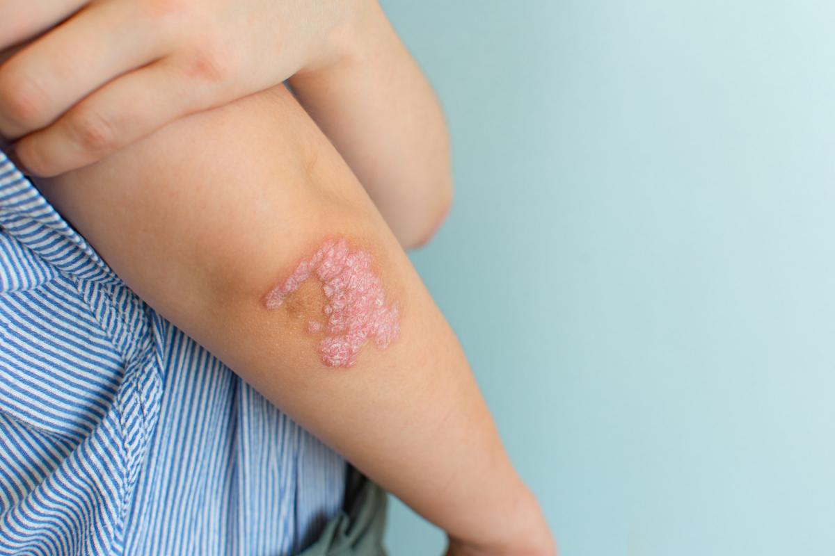 Five Skin Diseases Your Dermatologist Can Treat