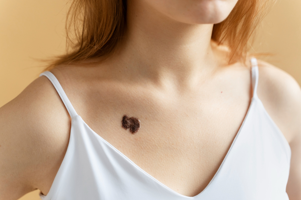 How Quickly Does Melanoma Grow and What Treatments Are Available?