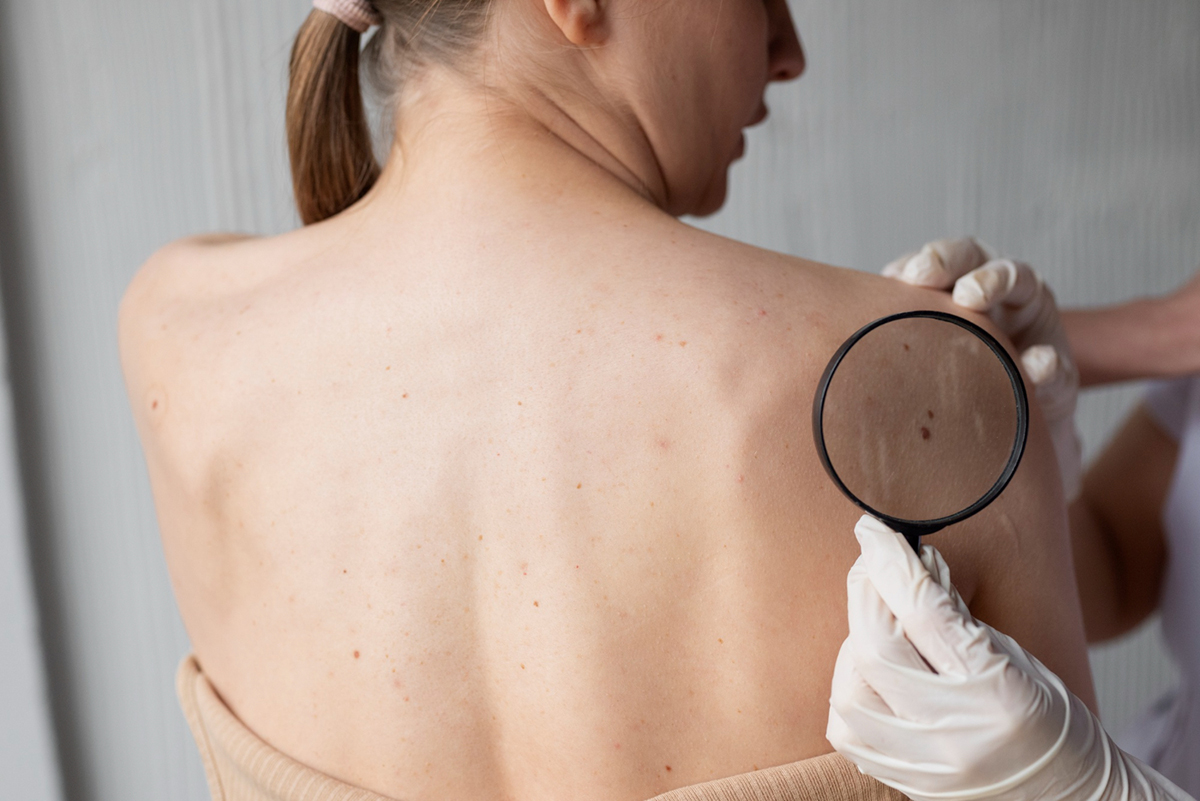 Early Detection of Melanoma: What You Need to Know