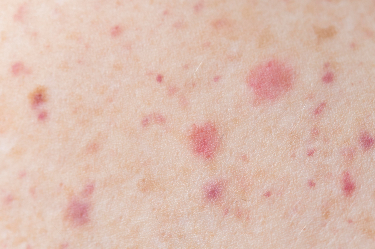 Atopic Dermatitis: Understanding and Treating This Skin Condition