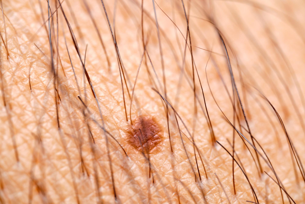 Identifying Hair Follicle Tumors: A Guide by Experts in Dermatopathology